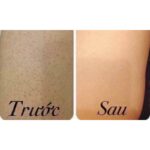 Trị Viêm Nang Lông Tại Nagoya Nhật Bản