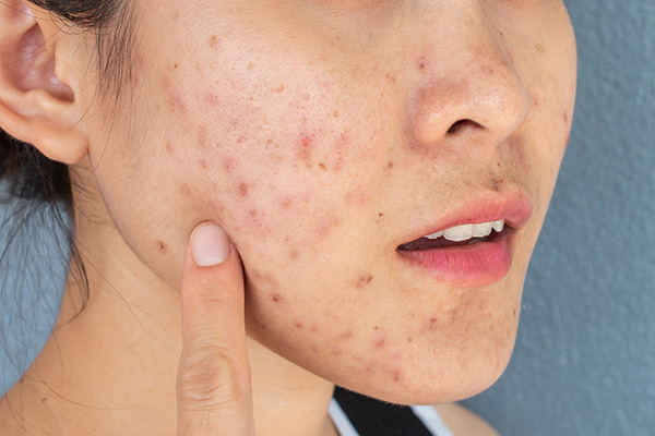Trị Mụn Tại Nhật Bản